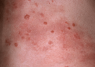 stade progressif du psoriasis