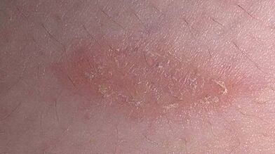 comment et avec quoi traiter le psoriasis