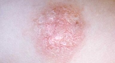 comment reconnaître le psoriasis à un stade précoce