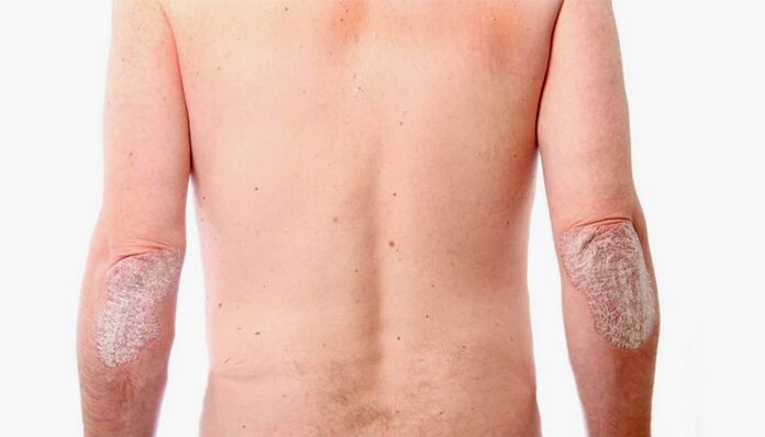 remèdes populaires pour le traitement du psoriasis