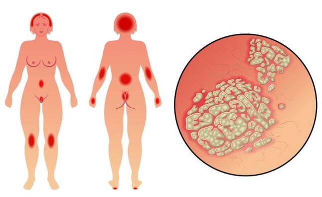 Symptômes du psoriasis