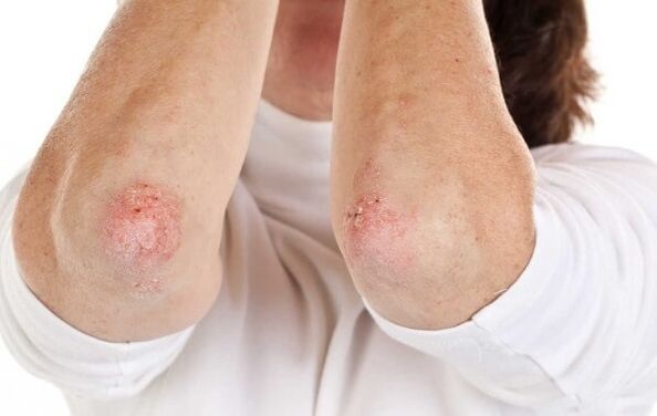 psoriasis