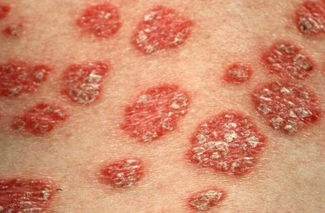 Papules psoriatiques