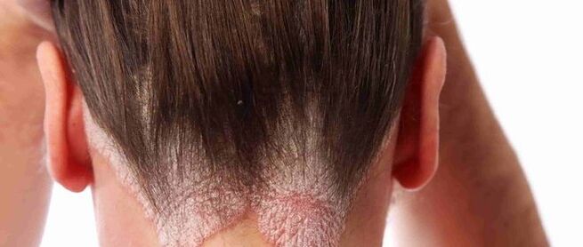 Psoriasis de la tête