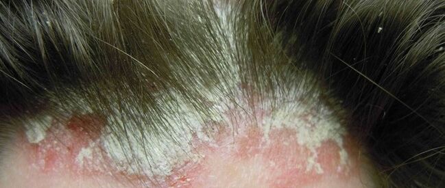 Psoriasis sur la tête
