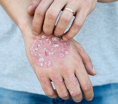Psoriasis sur le bras