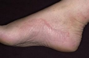 Psoriasis du pied