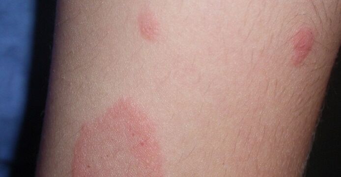 psoriasis