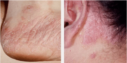 Types de psoriasis