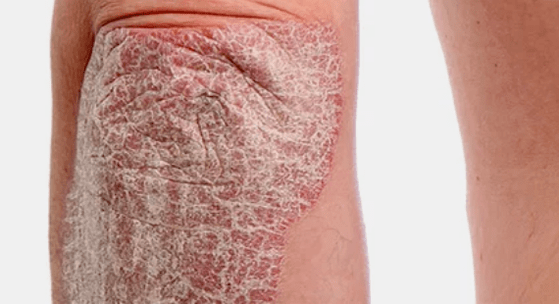psoriasis