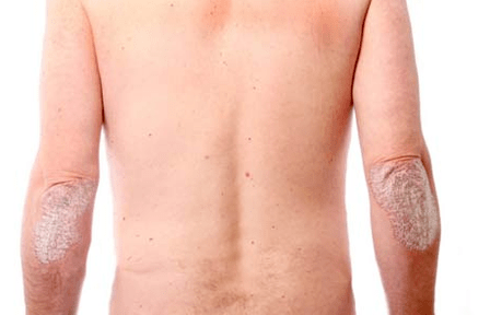 Symptômes généraux du psoriasis