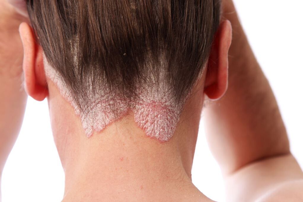 traitement du psoriasis