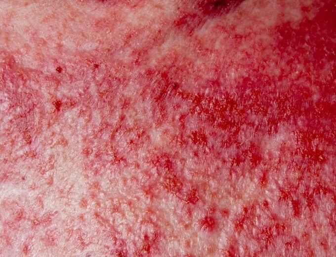 Forme avancée de psoriasis