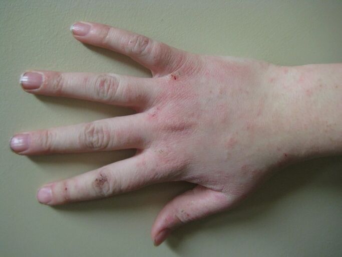 Le psoriasis à un stade précoce