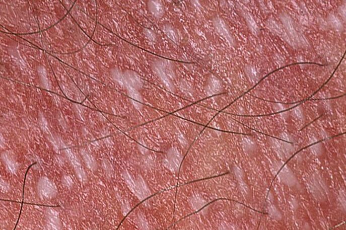 Psoriasis pustuleux