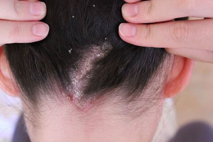 Psoriasis sur la tête
