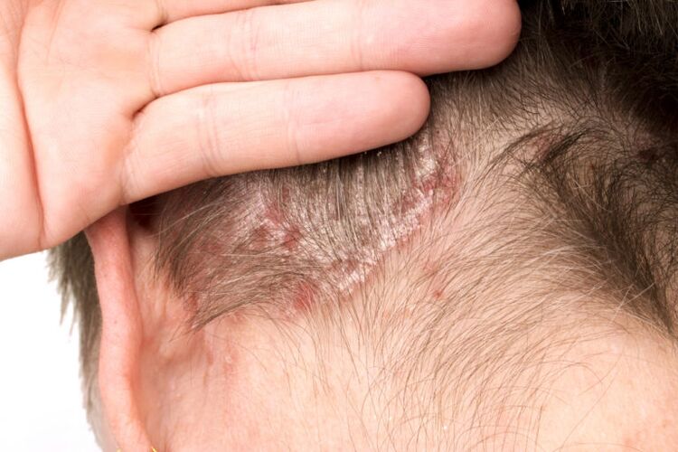 Exacerbation du psoriasis sur la tête