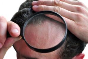Psoriasis sur la tête à travers une loupe