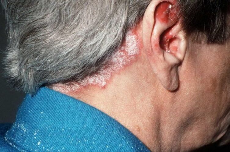 Psoriasis sur la tête