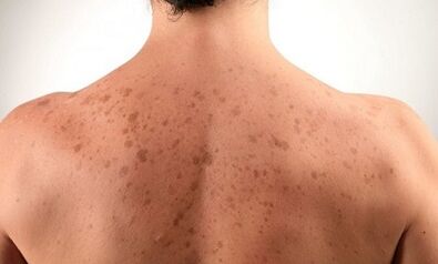 raisons du développement du psoriasis