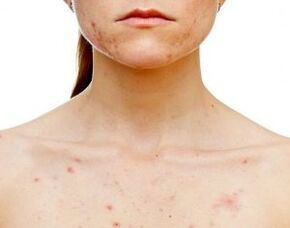 Sur quelles parties du corps apparaît le psoriasis 