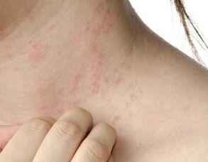 principaux symptômes du psoriasis