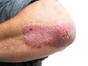 Psoriasis en plaques sur le coude