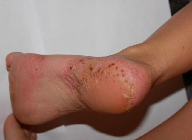 Psoriasis palmoplantaire