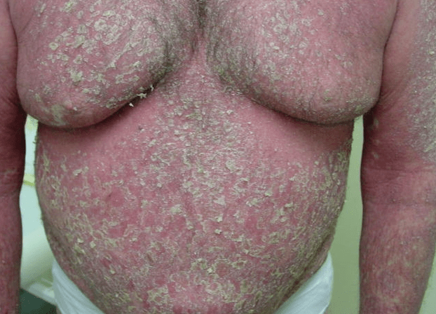 Érythrodermie psoriasique sur le corps