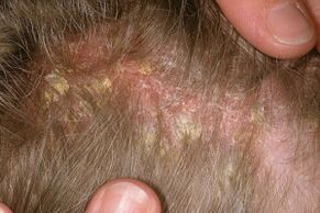 Psoriasis sur la tête