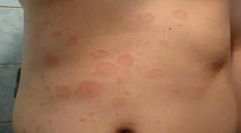 Psoriasis sur le corps