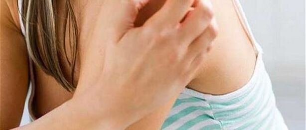psoriasis