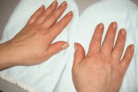Psoriasis des ongles